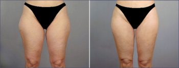 Liposuction Patient 7