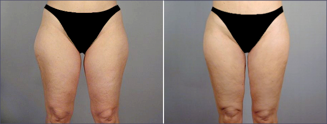Liposuction Patient 7