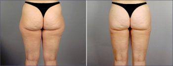 Liposuction Patient 7