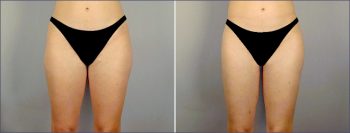Liposuction Patient 8