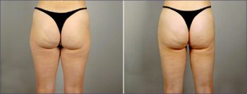 Liposuction Patient 8