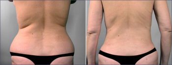 Liposuction Patient 9