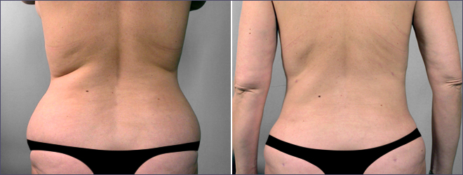 Liposuction Patient 9
