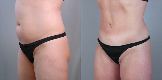 New Jersey Tummy Tuck Image New Jersey Tummy Tuck Image
