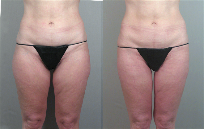 Liposuction Patient 11