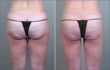 Liposuction Patient 11