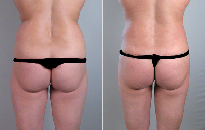 Liposuction Patient 12