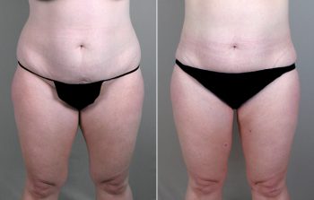 Liposuction Patient 13