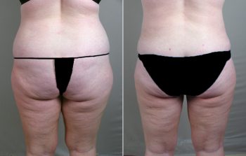 Liposuction Patient 13