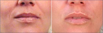 Lip Enhancement Patient 2