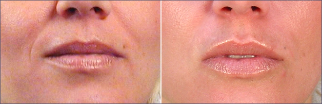 Lip Enhancement Patient 2