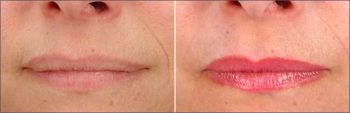 Lip Enhancement Patient 3