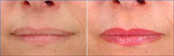 Lip Enhancement Patient 3