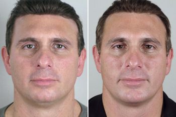 Male Rhinoplasty Patient 4