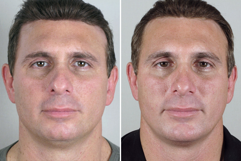 Male Rhinoplasty Patient 4