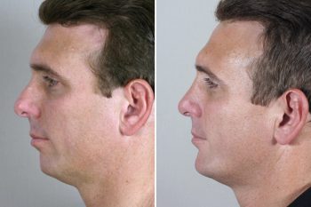 Male Rhinoplasty Patient 4