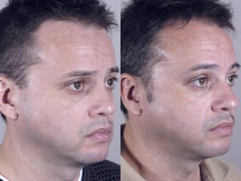 Male Eyelid Lift Patient 6