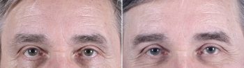 Male Facelift Patient 5