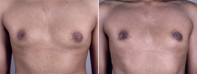 Gynecomastia Reduction Patient 10