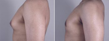 Gynecomastia Reduction Patient 10