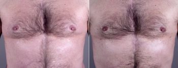 Gynecomastia Reduction Patient 11