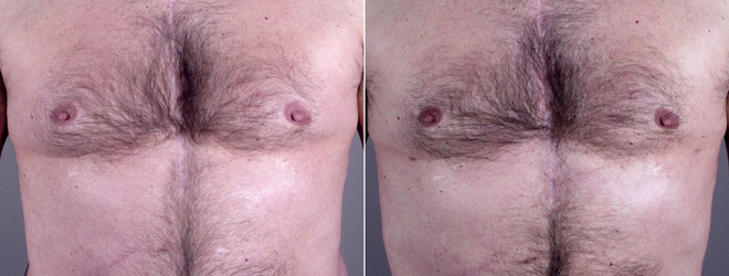 Gynecomastia Reduction Patient 11