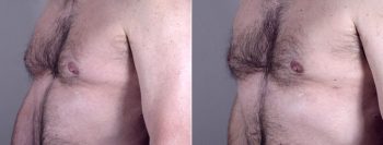 Gynecomastia Reduction Patient 11