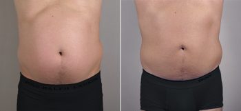 Male Liposuction Patient 2