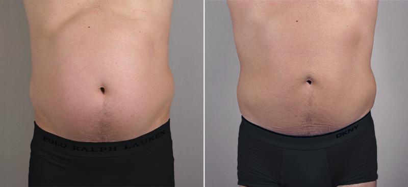 Male Liposuction Patient 2