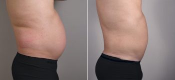 Male Liposuction Patient 2