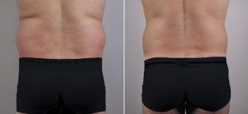 Male Liposuction Patient 2