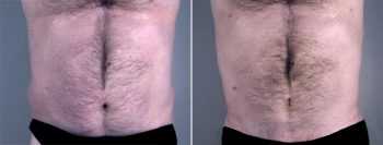 Gynecomastia Reduction Patient 11