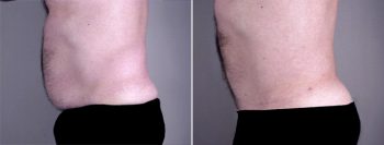 Gynecomastia Reduction Patient 11