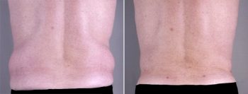 Gynecomastia Reduction Patient 11