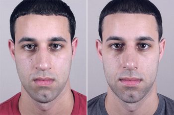 Male Rhinoplasty Patient 8