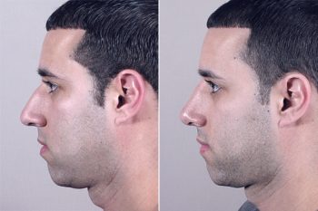 Male Rhinoplasty Patient 8