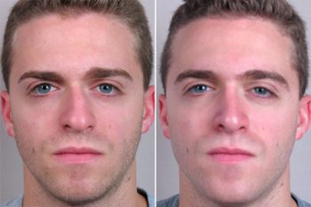 Male Rhinoplasty Patient 9