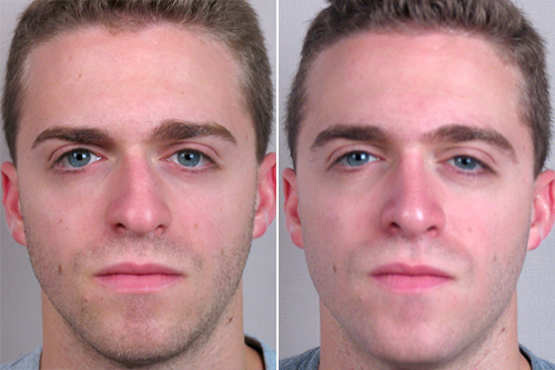 Male Rhinoplasty Patient 9