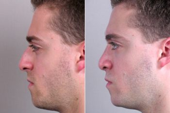 Male Rhinoplasty Patient 9