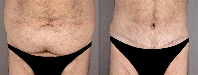 Male Abdominoplasty Patient 1