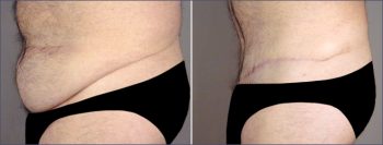 Male Abdominoplasty Patient 1