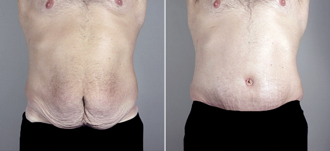 Male Abdominoplasty Patient 3