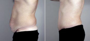 Male Abdominoplasty Patient 3