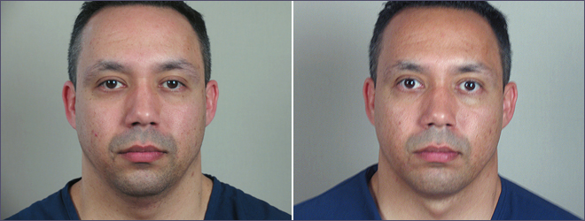 Male Neck Contouring Patient 2