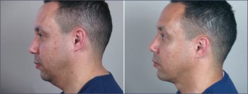Male Neck Contouring Patient 2