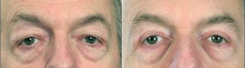Male Eyelid Lift Patient 1