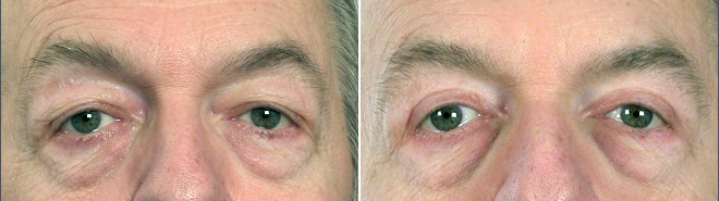 Male Eyelid Lift Patient 1