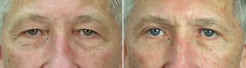 Male Facelift Patient 2