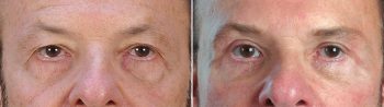 Male Facelift Patient 3