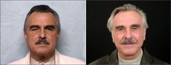 Male Facelift Patient 1